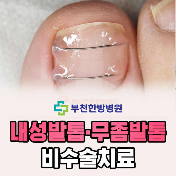 내성발톱·무좀발톱