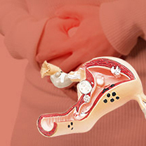 자궁난소 수술재활